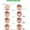 经尿道柱状水囊前列腺扩开术技术介绍